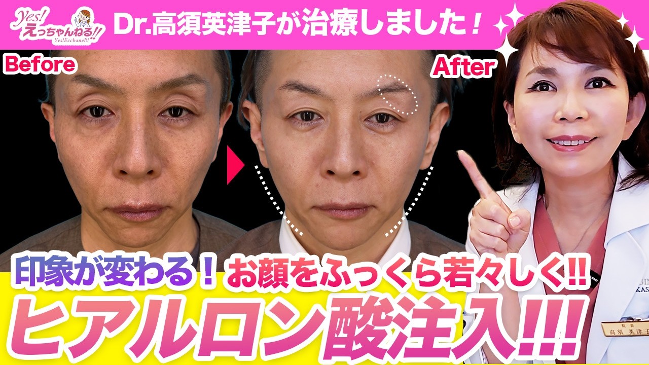 スッキリ若々しく！男性のヒアルロン酸注入を紹介します【くぼみ目】【こめかみ】【フェイスライン】