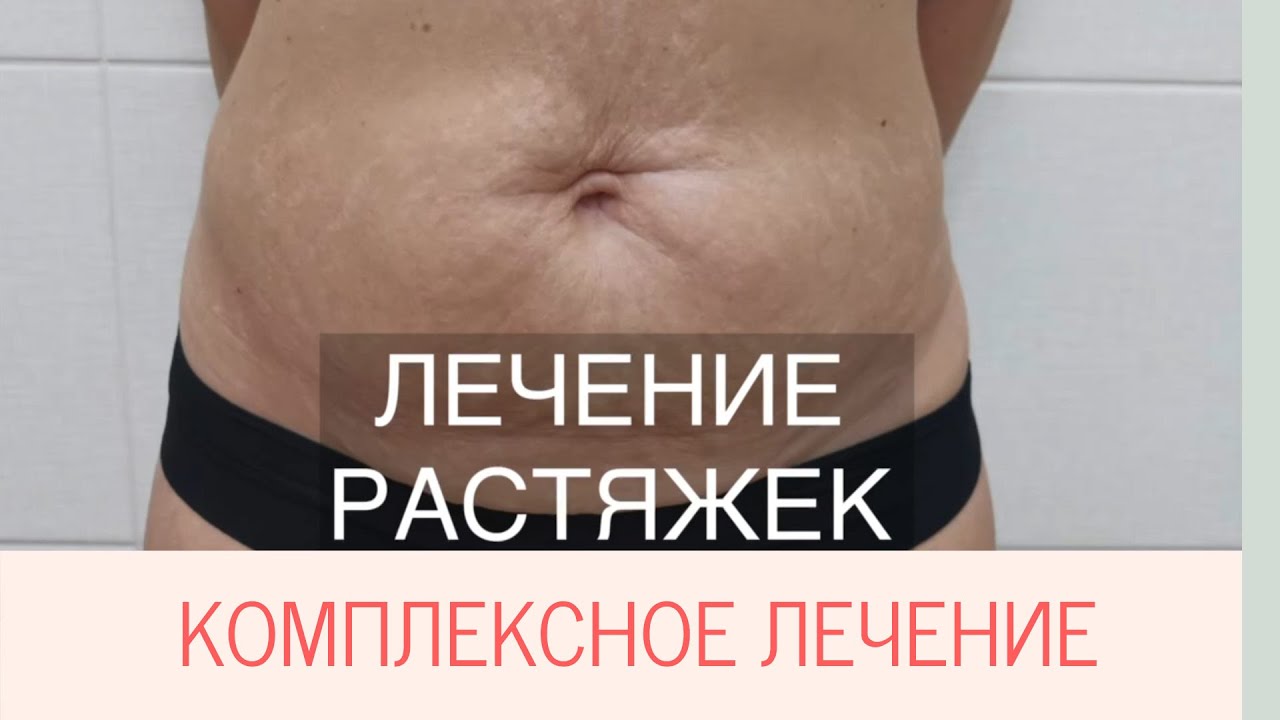 Лечение растяжек. до и после