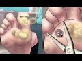 Satisfying! foot wart treatment | screw nail removal | tingle sound