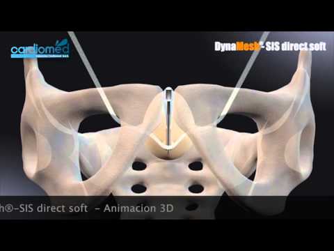 DynaMesh® SIS direct soft    Animacion 3D