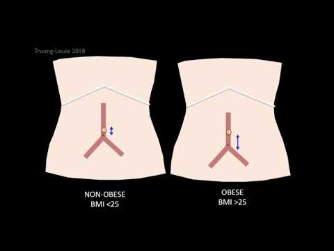 Peritoneal Entry for Laparoscopic Surgery: Techniques, Tips, and Tricks