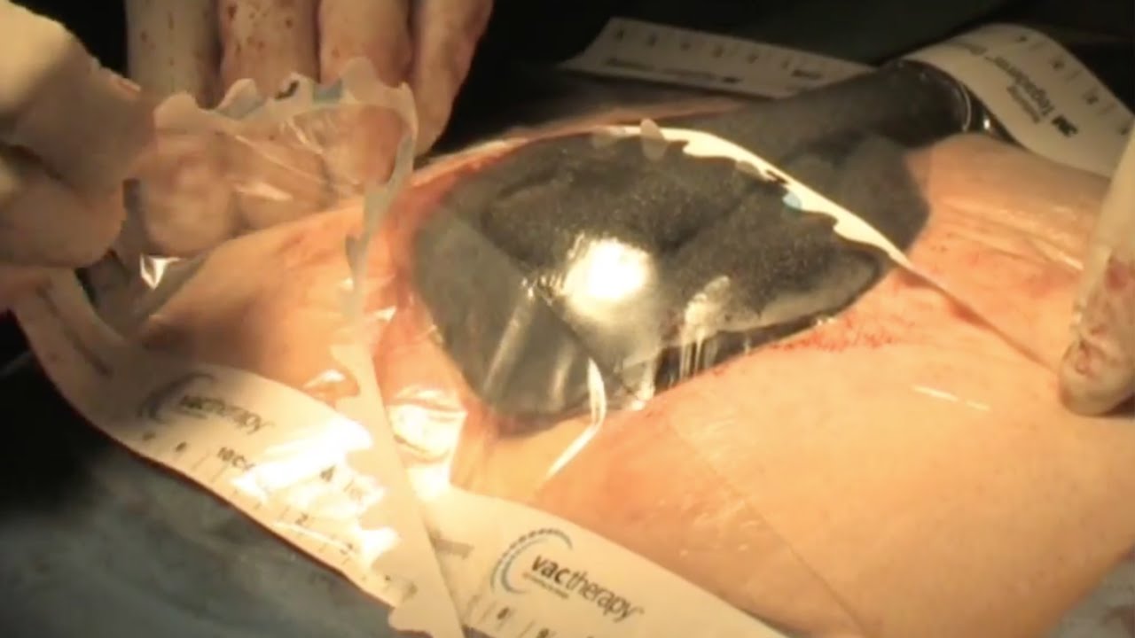 Pilonidal Sinus - excision and healing using a vacuum dressing
