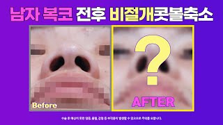 남자복코 전후증례 : 남자 넓고 큰 코성형, 남자 비절개콧볼축소