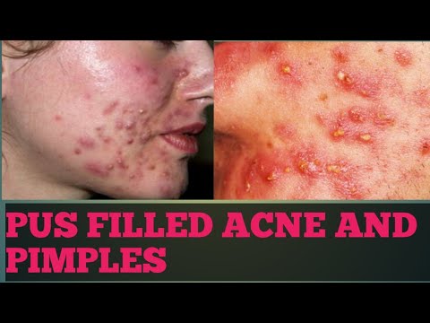 PUS FILLED ACNE AND PIMPLES ||   IN FEW DAYS WITH 2 REMEDIES