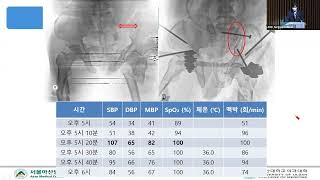 7th AMC Surgical Critical Care Symposium : How to reduce transfusion in pelvic injury patients 미리보기