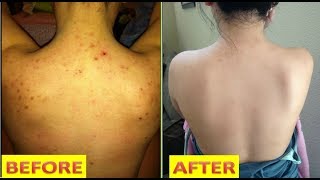 GET RID OF BACK ACNE IN JUST 7 DAYS || 100% EFFECTIVE HOME REMEDY || youtube