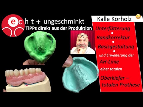Unterfütterung, Randkorrektur und Erweiterung der AH-Linie einer oberen totalen Prothese