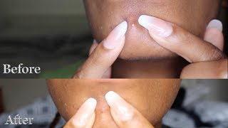 Getting Rid Of Pimples Overnight REALISTIC Remedy tested? || SHANIEL MCKENZIE