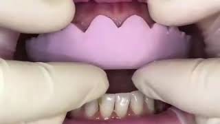 Mock up before ceramic-porcelain veneers | Hollywood smile | Dentist Beirut Lebanon