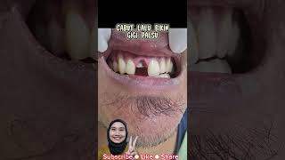 Download lagu GIGI DEPAN PATAH KARENA KEROPOS | drg. Shanti Yuniwardani mp3 Download lagu GIGI DEPAN PATAH KARENA KEROPOS | drg. Shanti Yuniwardani mp3
