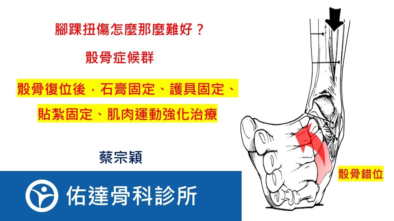 【骰骨復位後，石膏固定、護具固定、貼紮固定、肌肉運動強化治療】骰骨症候群、骰骨錯位症候群、骰骨脫位錯位、骰骨卡住、Cuboid syndrome。【佑達骨科】【蔡宗穎醫師】 - AI健康醫療影片