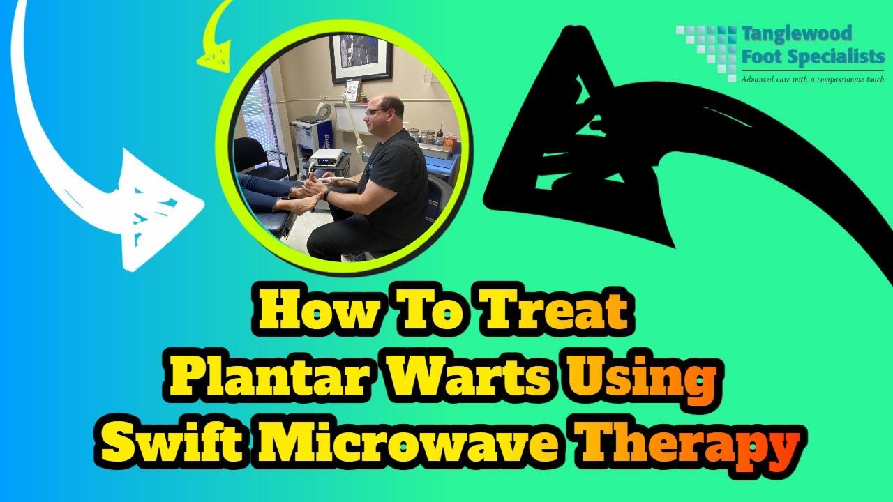 How To Treat Plantar Warts Using Swift Microwave Therapy