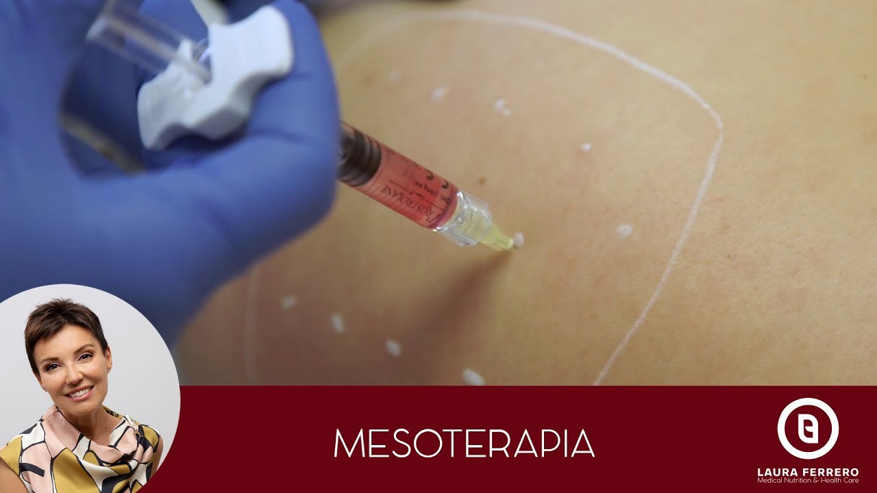 Watch Now Mesoterapia - Dott. Laura Ferrero - Medicina Estetica Torino Mesoterapia - Dott. Laura Ferrero - Medicina Estetica Torino