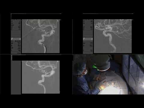 Ruptured dural AVF with cortical venous drainage treated with onyx