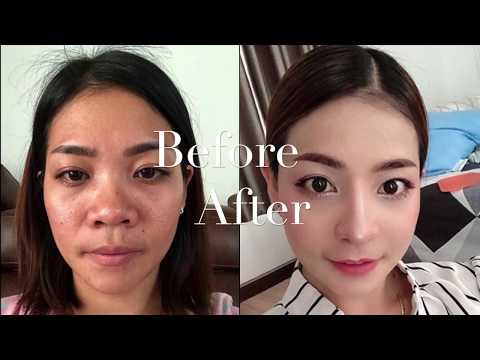 download lagu mp3 mp4 Nose Job In Thailand Price, download lagu Nose Job In Thailand Price gratis, unduh video klip Nose Job In Thailand Price