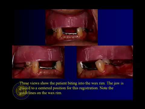 Implant-Supported Dentures