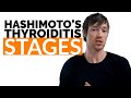 6 Stages of Hashimoto's Thyroiditis That ALL Patients Go Through