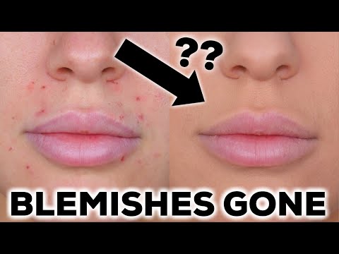HOW TO COVER ACNE, PIMPLES & BLEMISHES!!