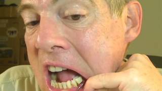 t19 M1-Distal - 1 - ROCKPILE BOSS - periodontal abscess