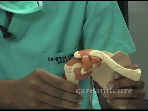 Shoulder Dislocations - Everything You Need To Know| Dr Nithin Kumar| joint Replacement