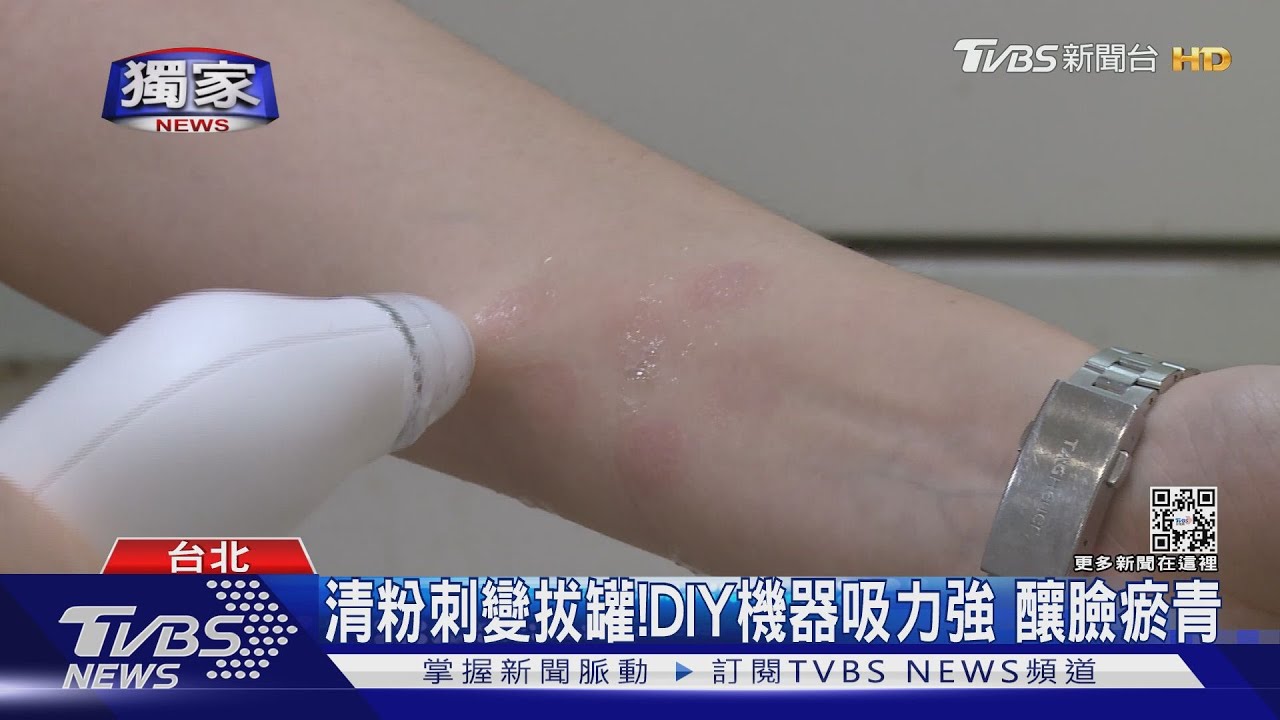 清粉刺變拔罐！ DIY機器吸力強　釀臉瘀青