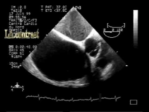 Mitral Stenosis In Different Aspects: LA Spontaneous contrast.