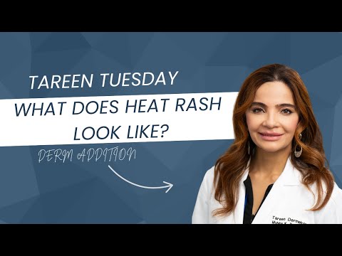 Hot, itchy, and bumpy? It might be heat rash. ☀️