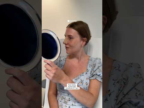 Nose taping | Dr. med. Simon Zimmermann