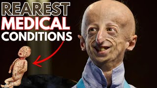 Top 10 Rarest Medical Conditions That Will Make You Squirm