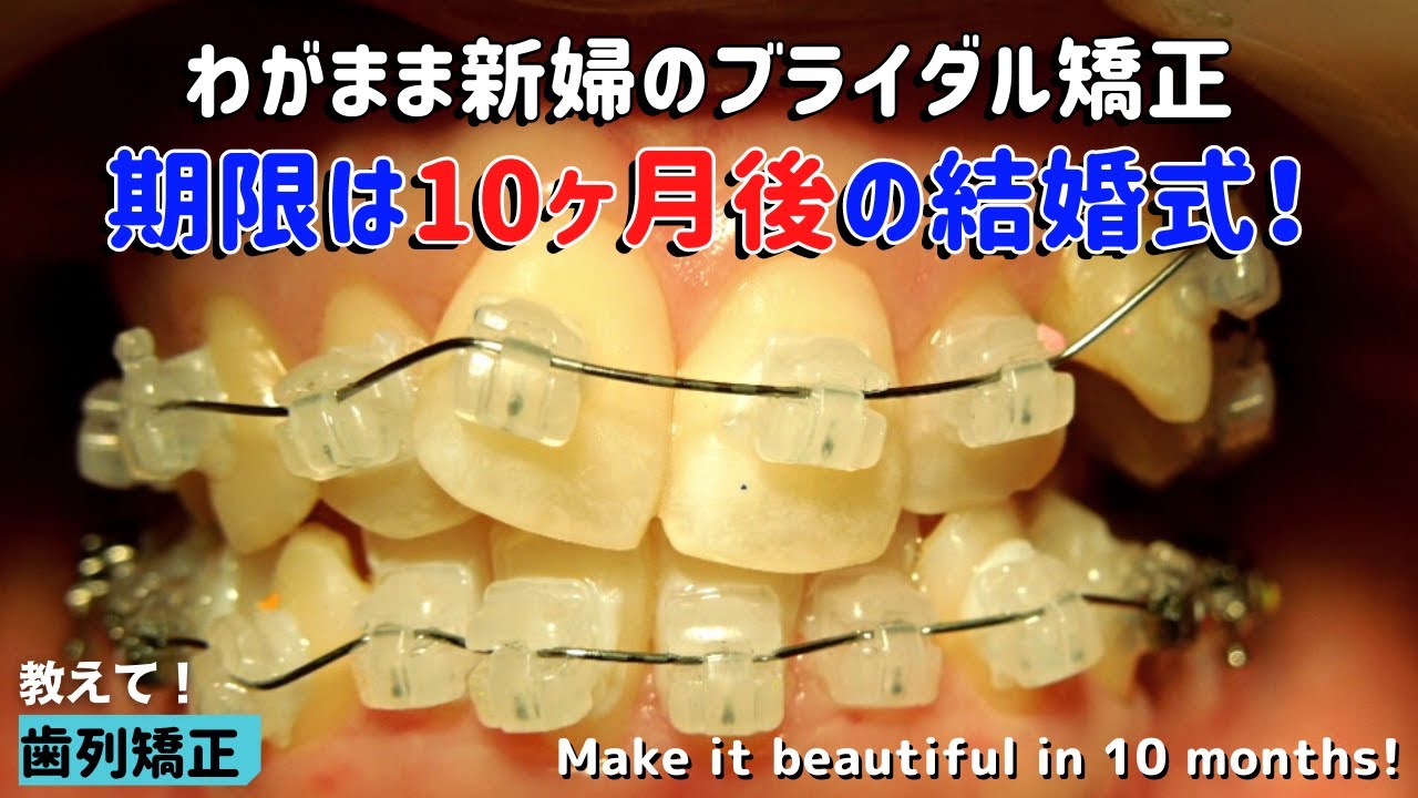 【歯列矯正】10ヶ月後の結婚式までに綺麗にしてください！
