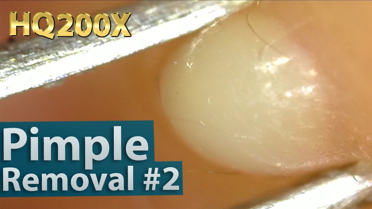 #2 Pimple(acne) Removal Close up 200X - Blackheads Removal | 200倍でニキビを潰す芯を除去