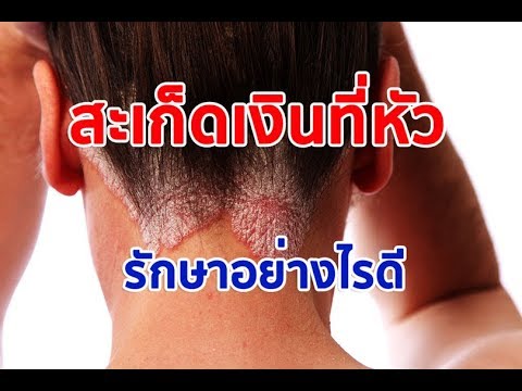 ร้องไห้กลากบนนิ้วเท้า Collagenaria สำหรับโรคสะเก็ดเงิน