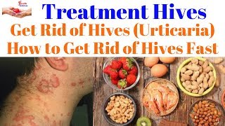 Treatment Hives - Get Rid of Hives (Urticaria) - How to Get Rid of Hives Fast  😀-
