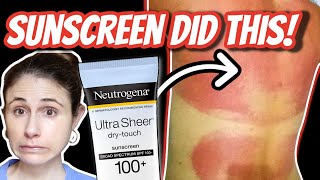 SUNSCREEN allergic reactions and rashes| Dr Dray