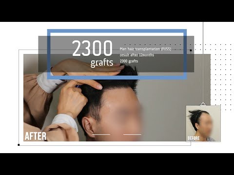 Man hair transplantation results after 12month - 뉴헤어 I 모발이식 I Before and After I