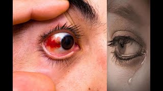 BEST WAY TO GET RID OF  BLOODSHOT EYES WITHOUT EYE DROPS (from conjunctivitis)