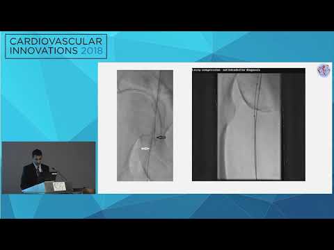 CVI2018 Session: A combined radial & pedal access to treat a flush CTO - Qais Radaideh