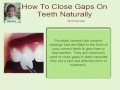 How To Close Gaps On Teeth Naturally 