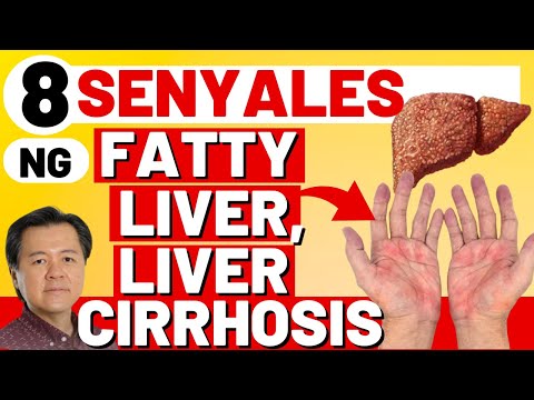 8 Senyales ng Fatty Liver, Liver Cirrhosis. - By Doc Willie Ong (Internist and Cardiologist)