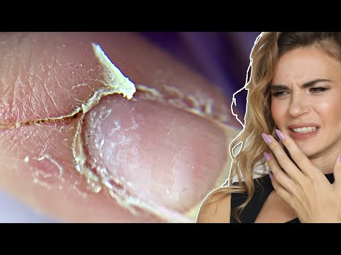 Bitten Nails & Sliced Cuticle Transformation