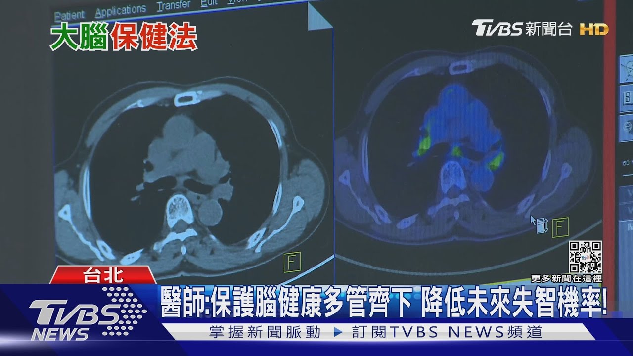 保護腦健康！　醫師：從「這幾個」危險因子預防否則下場慘！