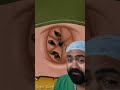 Doctor Reacts To Lost Baggage In Bellybutton