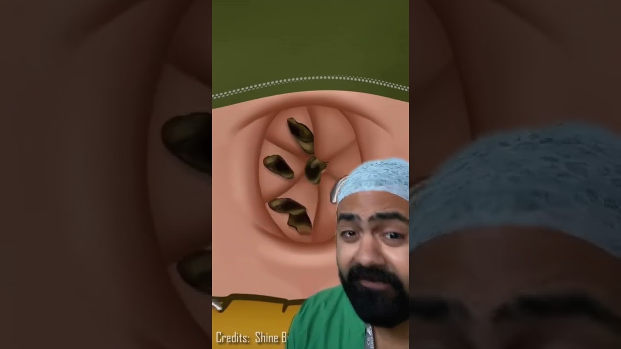 Doctor Reacts To Lost Baggage In Bellybutton