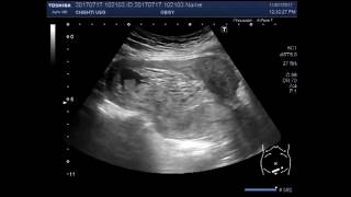 Ultrasound Video showing an incomplete abortion with retained products of conception.