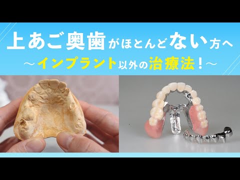 上あご奥歯がほとんどない方へ 〜インプラント以外の治療法！〜