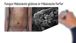 Skin fungal infection -Tinea versicolor  symptoms, causes, Treatment