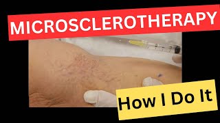 Microsclerotherapy Injections for Leg Spider Veins; My Low, Slow, Low, HOLD, Method