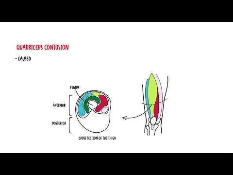 Quadriceps Muscle - Quadriceps Muscle Injury, Strain, Quadriceps Contusion