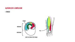 Quadriceps Muscle - quadriceps mujscle injury, strain, quadriceps contusion