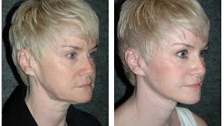 Mini Facelift by Dr Andrew Jacono #minifacelift